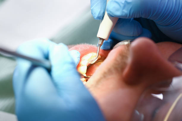 Best Emergency Tooth Extraction in Haskell, OK